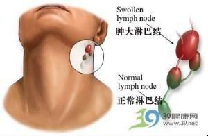 你颈部的淋巴发炎、肿大吗?