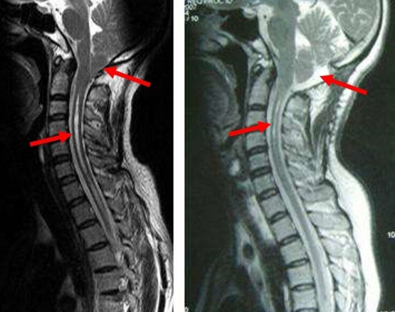 脊髓空洞病图片