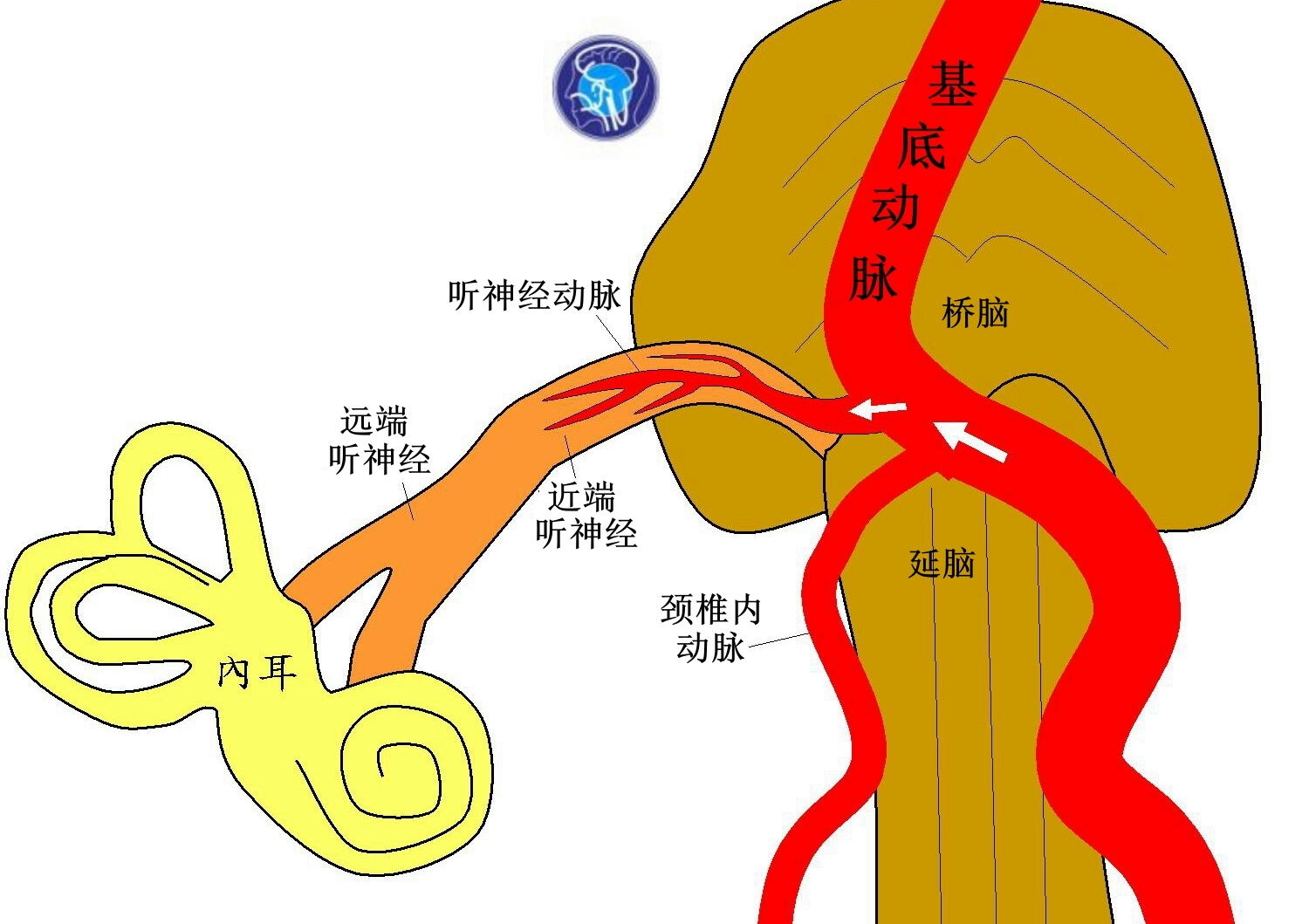 核磁共振检查显示基底动脉管径扩大,且向右扭曲,左侧颈椎内动脉较右侧
