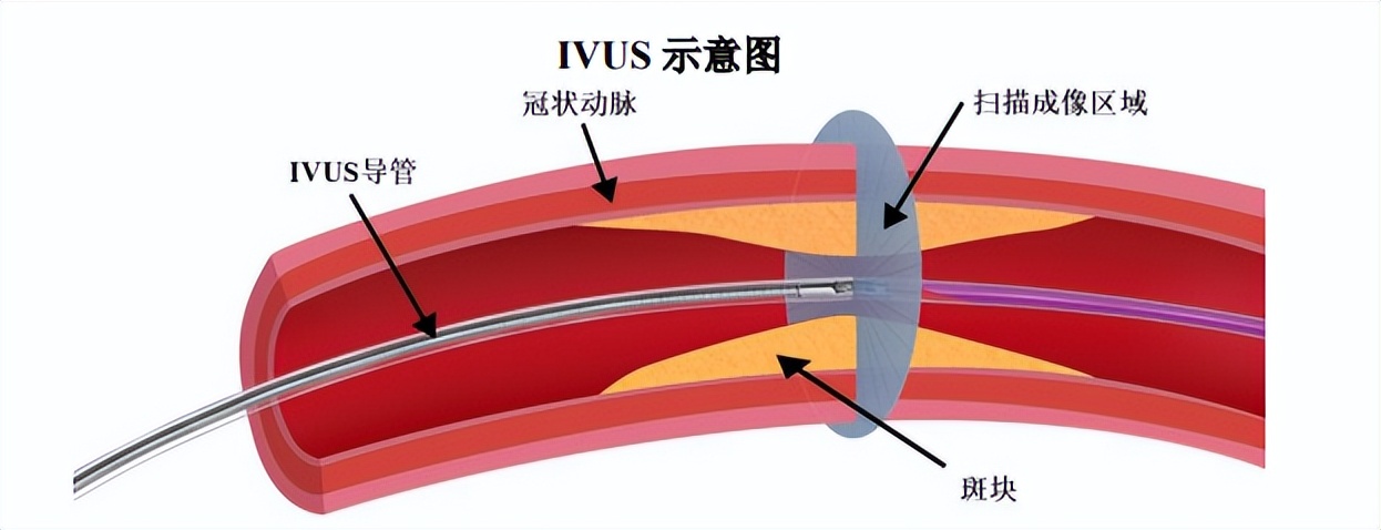 动脉换能器调零示意图图片