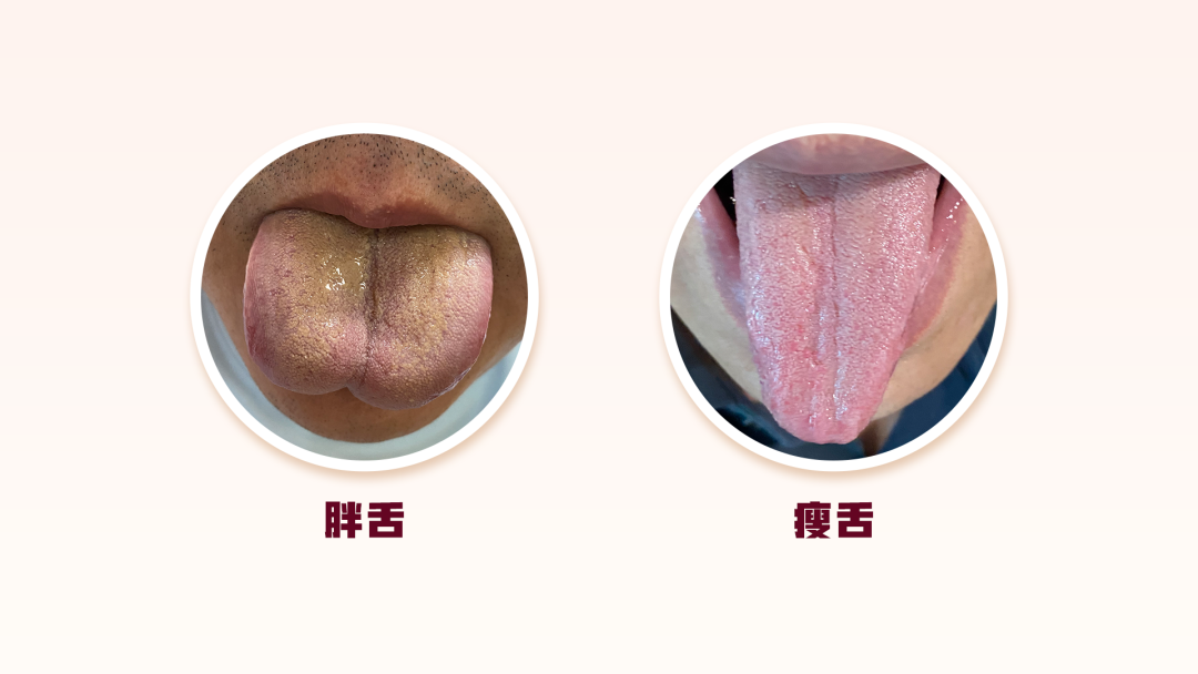 舌体胖大:提示体内水湿较多,或痰浊上泛.