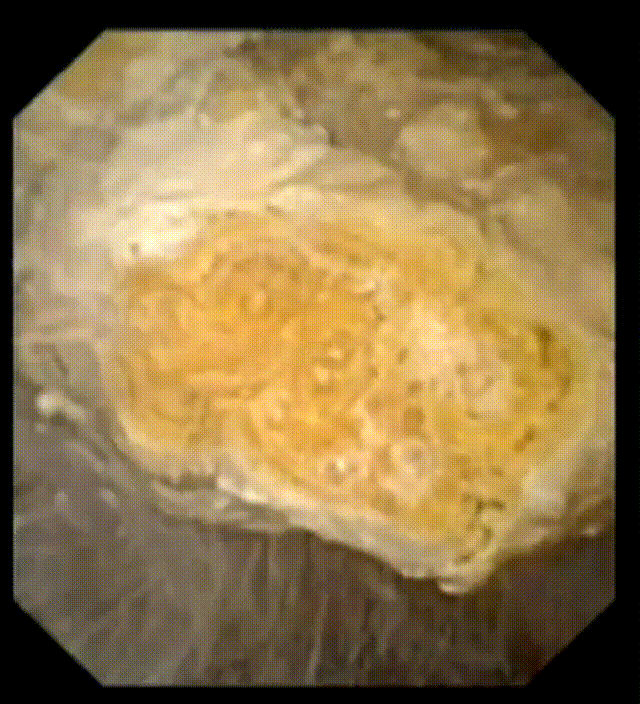 钬激光有哪些品牌进口十年磨一剑，专精特新“小巨人”瑞柯恩靠着钬激光跑出全国第一_https://www.jmylbn.com_新闻资讯_第7张