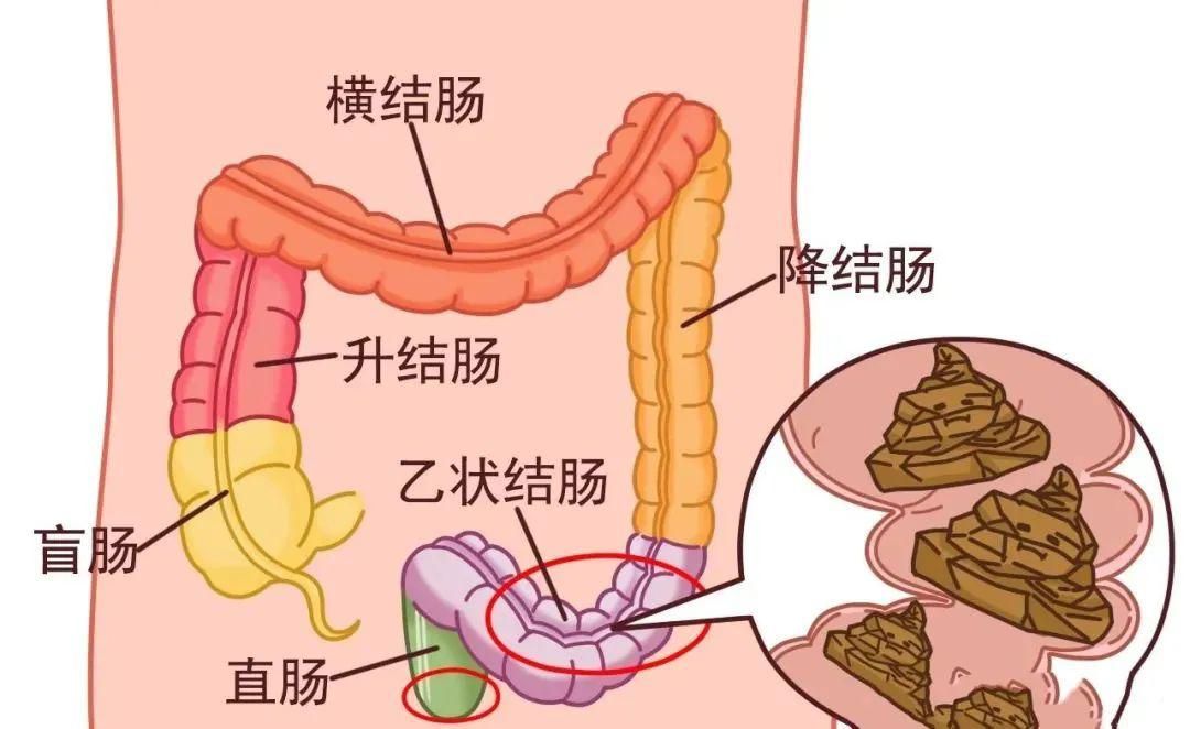 乙状结肠的位置图图片
