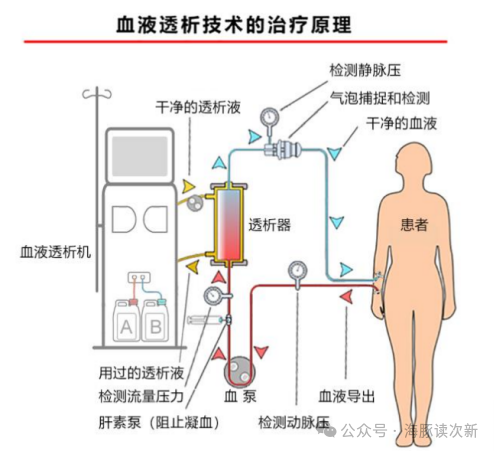 血液透析滤过原理图图片