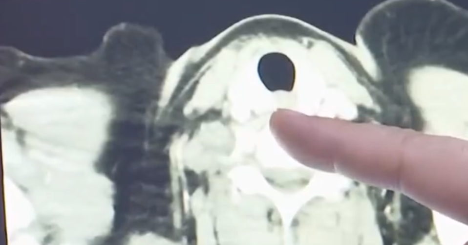 穿刺显示,三个人均为甲状腺状癌.