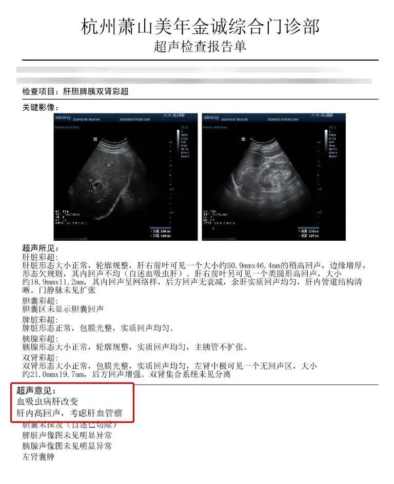 彩超结果显示 肝右前叶可见一个大小约50 9mmx46