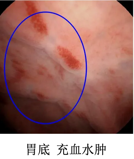 胃角黏膜水肿图片