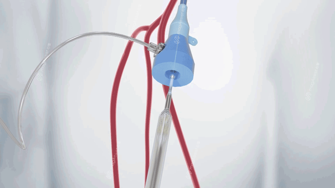 医疗公司有哪些产品器械之家：2024十大心血管创新产品_https://www.jmylbn.com_新闻资讯_第7张