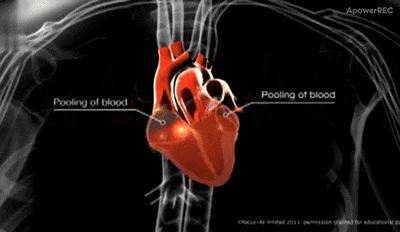 正常心脏收缩此外,心力衰竭,心梗,认知功能障碍,痴呆以及肾功能不全