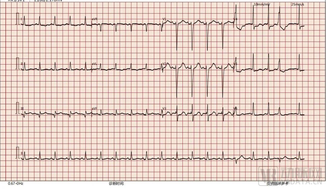 入院检查:心电图提示:窦性心动过速,前壁r波递增不良伴st段轻度压低.