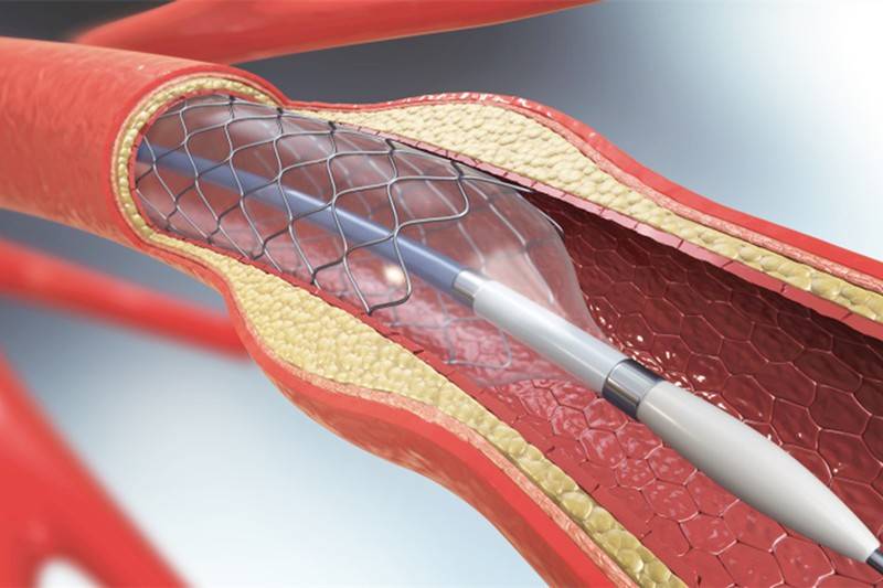 从700元涨至3万,心脏支架为何重回天价?