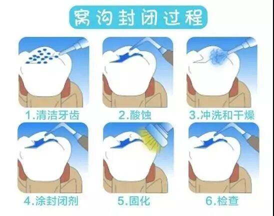 口镜怎么韩国五星丨口镜 妈妈们注意了，6成儿童蛀牙都发生在这牙上！_https://www.jmylbn.com_新闻资讯_第7张