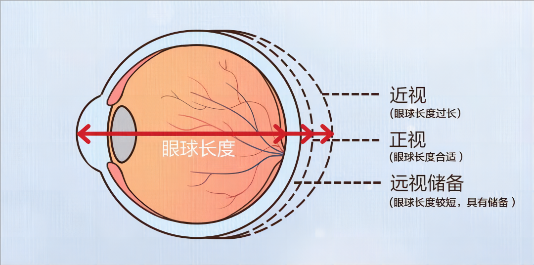 网传近视800度降到100度方法步骤详细有用吗