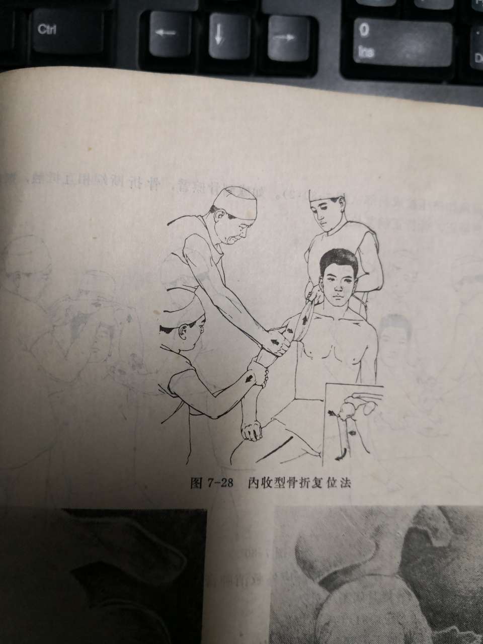 看下图左术前右术后这是以纯中医手法接骨以无需内固定的中医骨伤科小