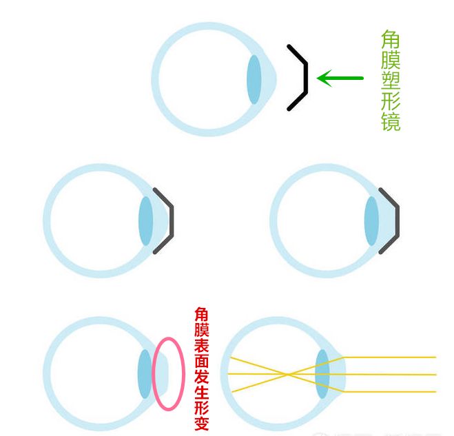 西宁爱尔:角膜塑形镜配戴方法是什么样呢_博客_东方财富网