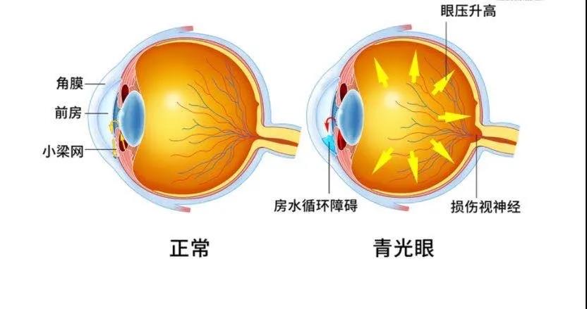 西宁爱尔:青光眼的高发人群是哪些?有没你?